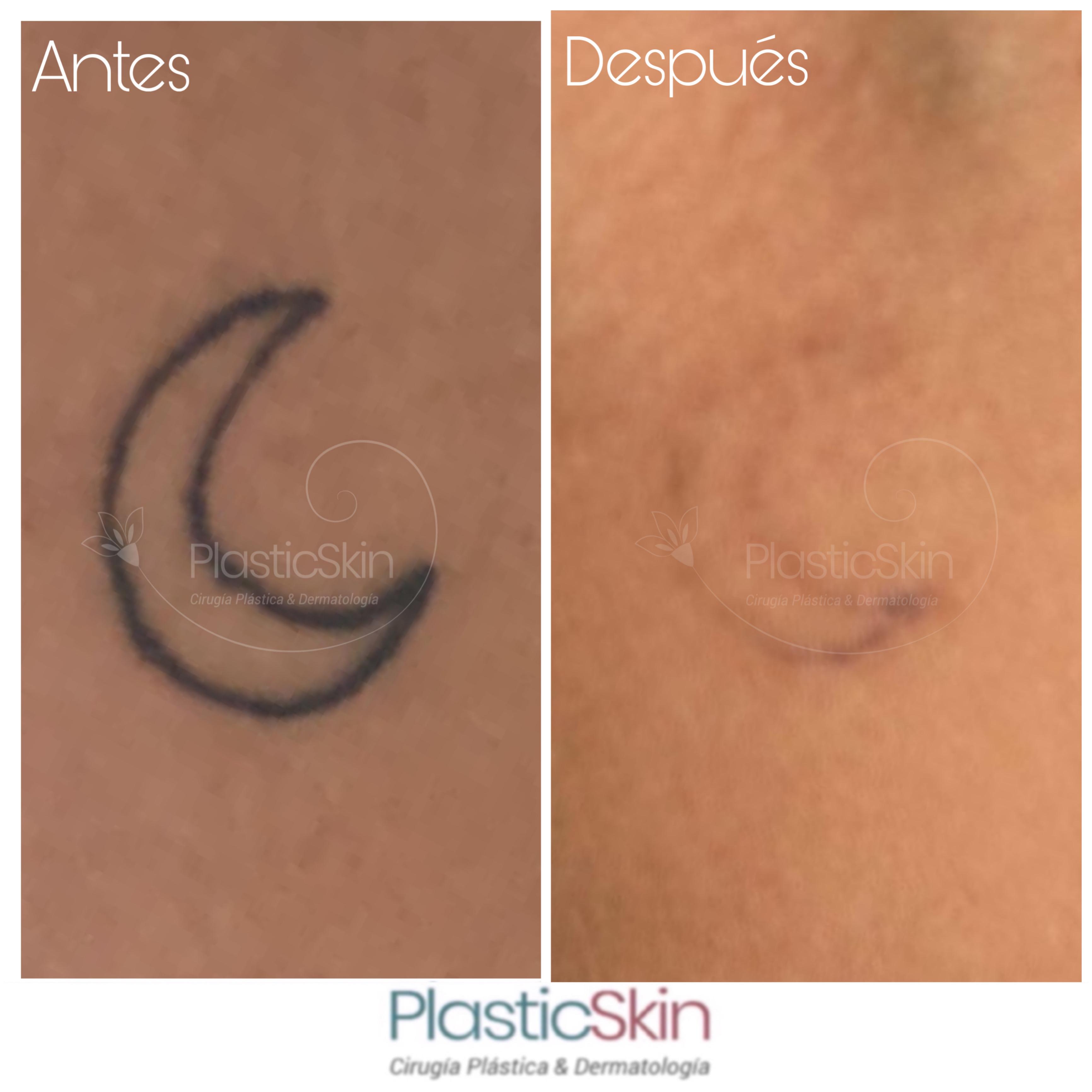 Tatuajes