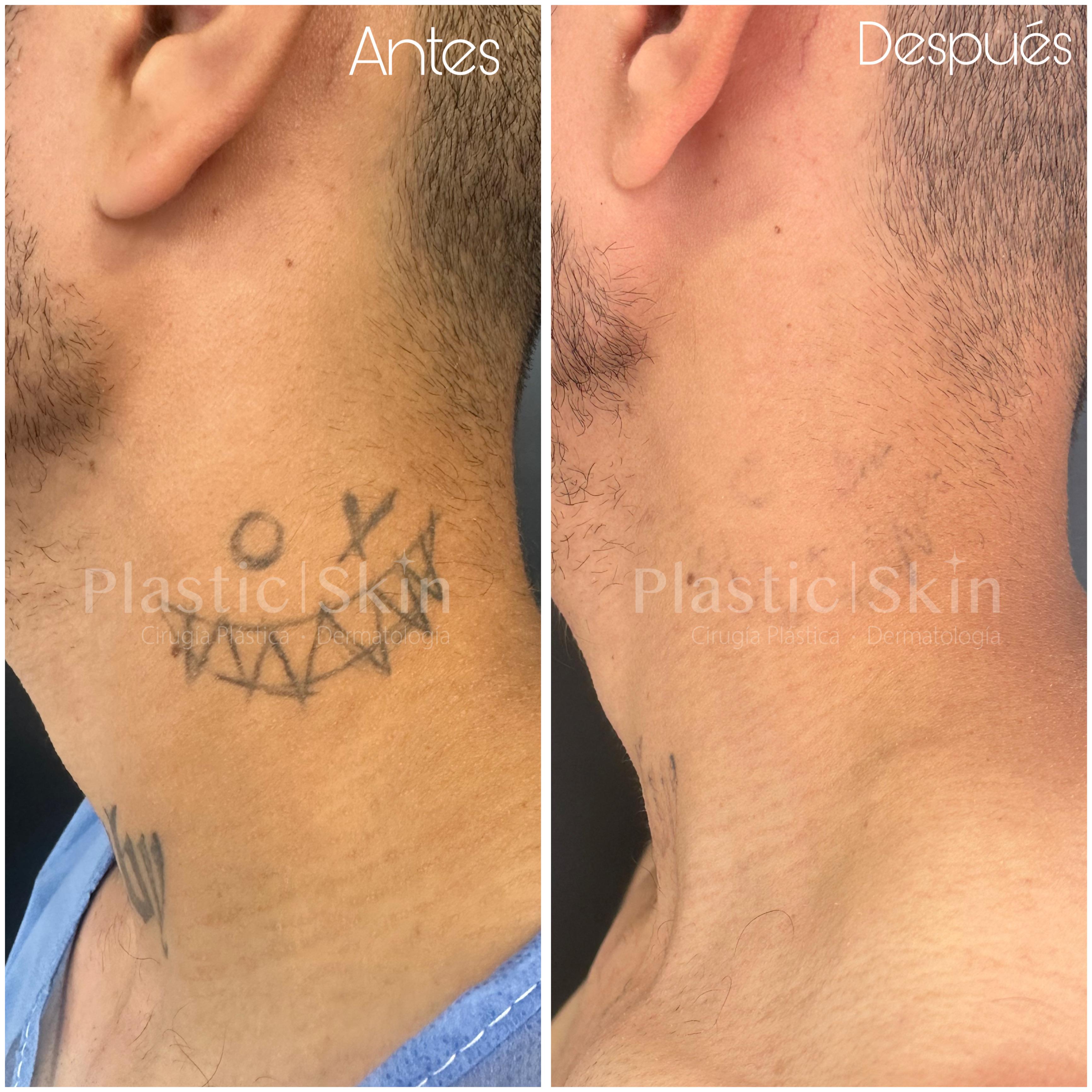 Tatuajes