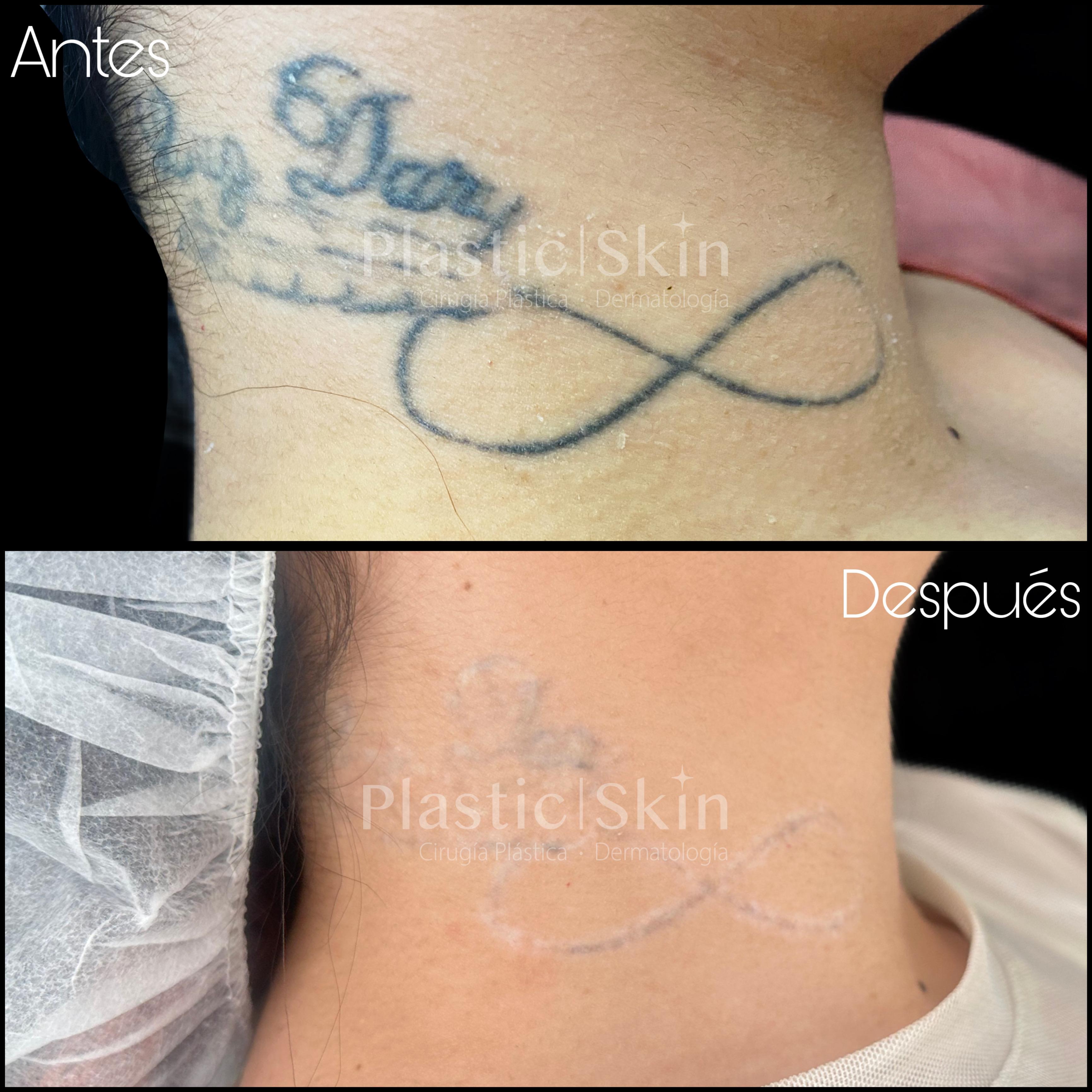 Tatuajes