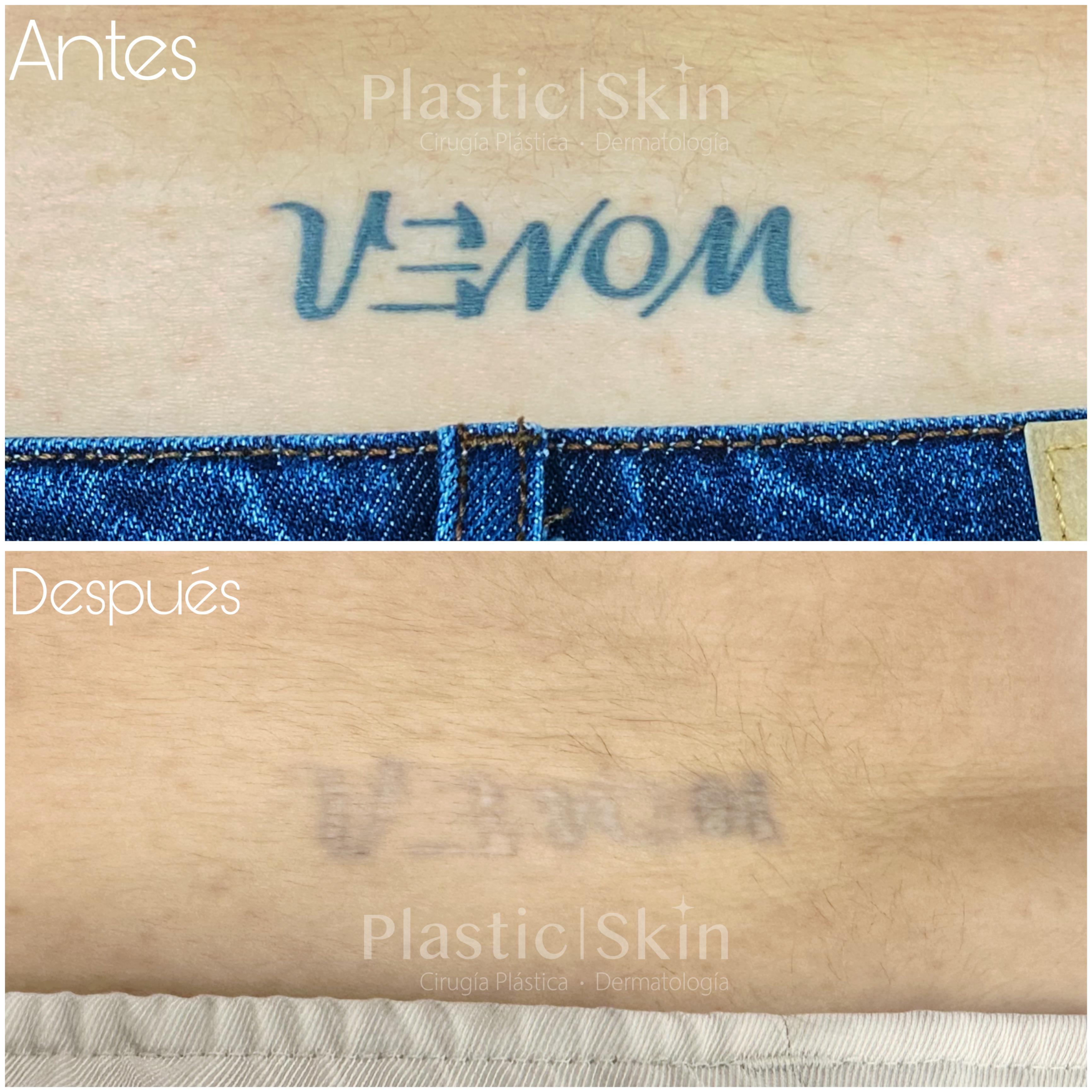 Tatuajes