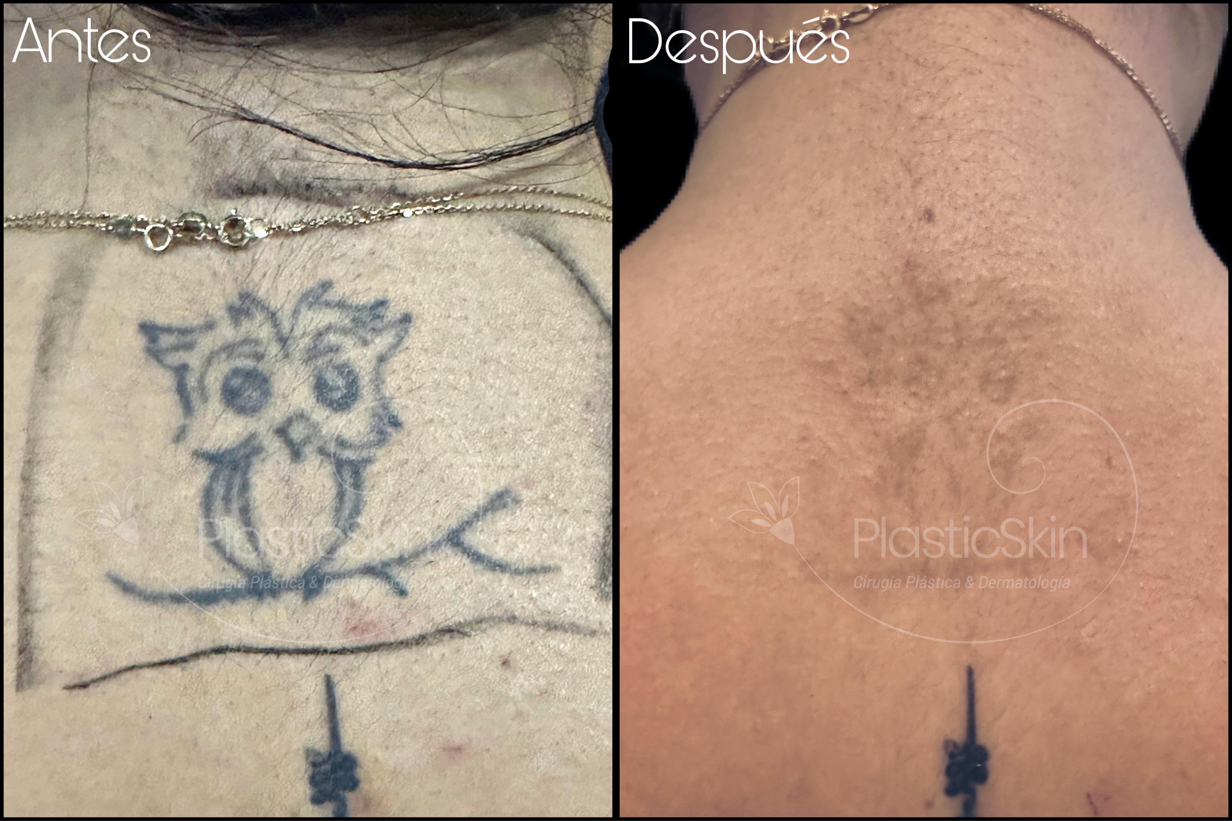 Tatuajes